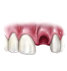 Injured Teeth | NW Endodontics