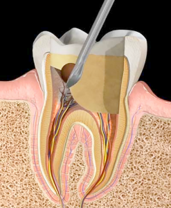 Pulpotemy | NW Endodontics
