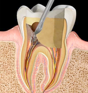 Pulpotemy | NW Endodontics